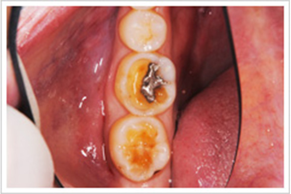 酸蝕歯　事例1