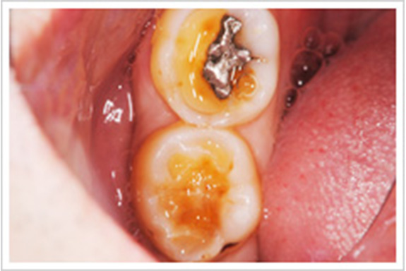 酸蝕歯　事例1