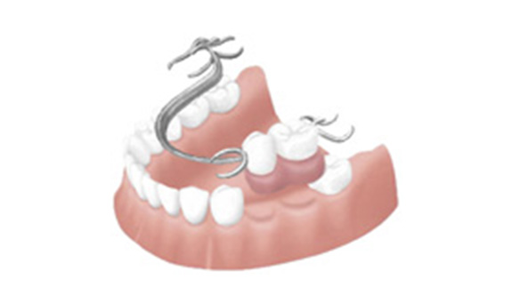 入れ歯（部分入れ歯、総入れ歯）
