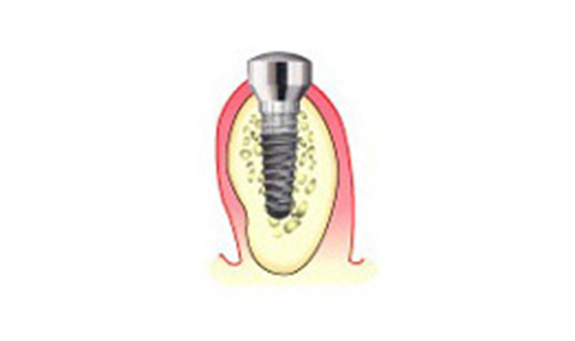 粘膜貫通部分と周囲組織の整備（2次手術）