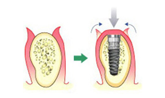 インプラント埋入手術（1次手術）